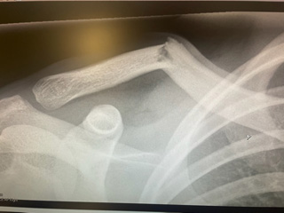 Riding was fun until it wasn't x-ray of broken collarbone